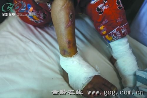 恶毒母亲烧红火钳烫12岁女儿全身 伤口处可见骨头