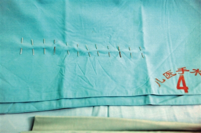 被扎针女婴体内12根针全部取出