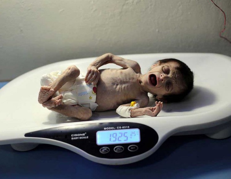 战乱下的叙利亚婴儿 因缺乏营养瘦骨如柴（图）