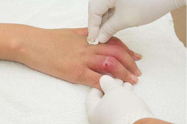 轻微伤不私了必须拘留吗?轻微伤不调解多久结案?